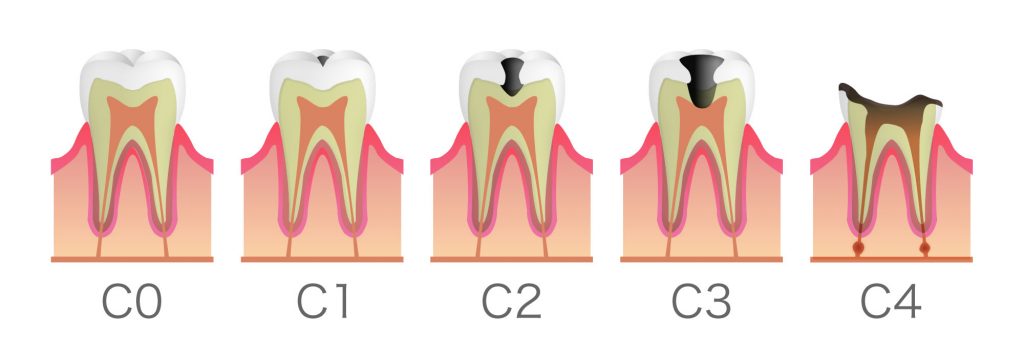むし歯の進行は5段階